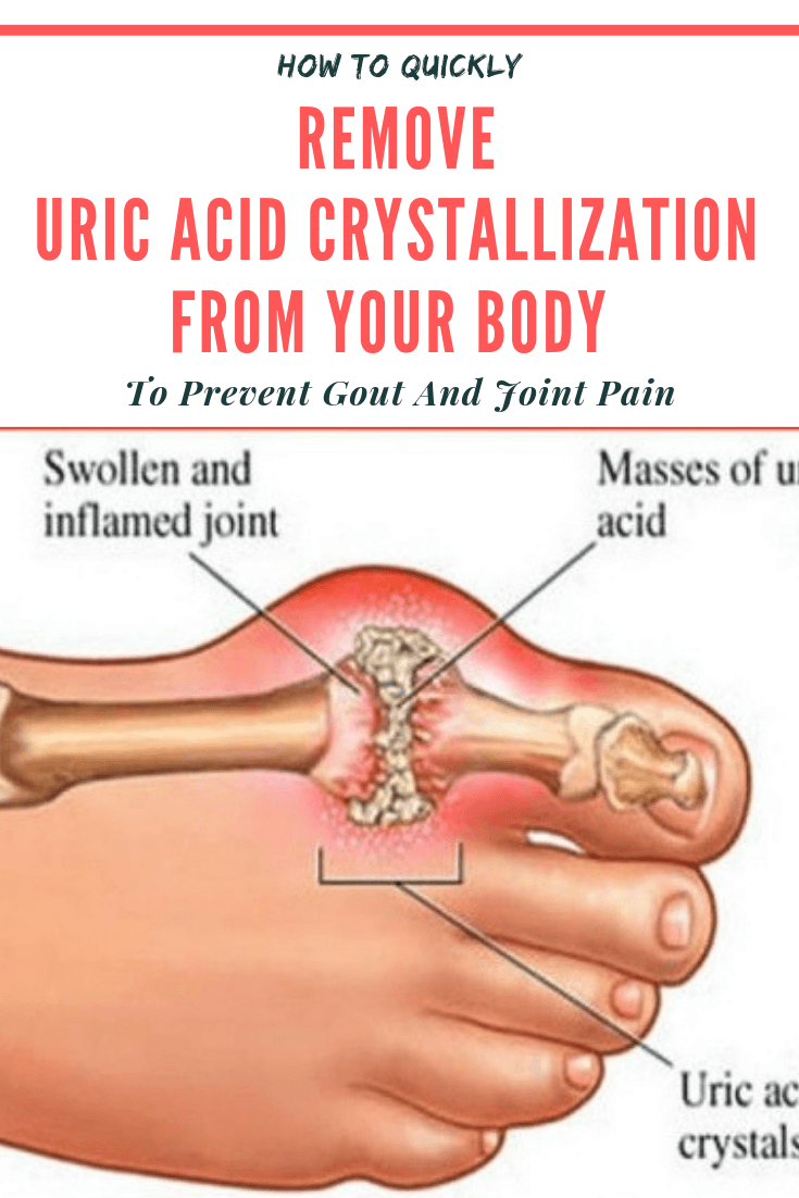 How To Quickly Remove Uric Acid Crystallization From Your Body To