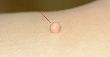 Risks of DIY Skin Tag Removal