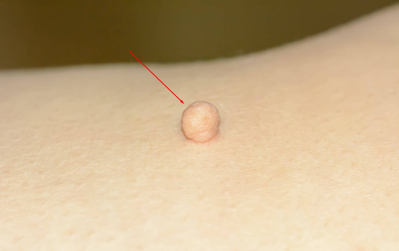 Risks of DIY Skin Tag Removal